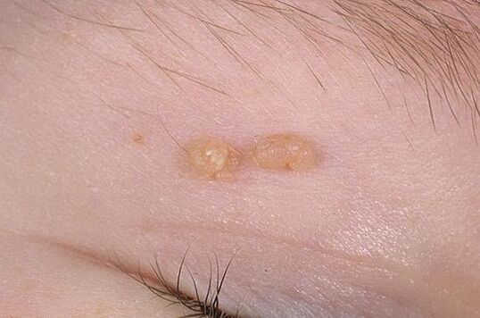 Papilloma ordinario