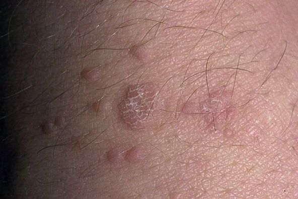 Papilloma piatto