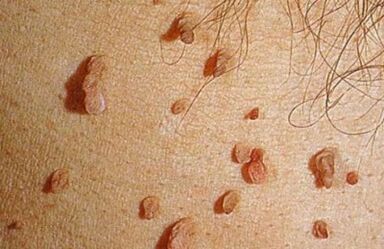 Come si manifesta il virus del papilloma umano