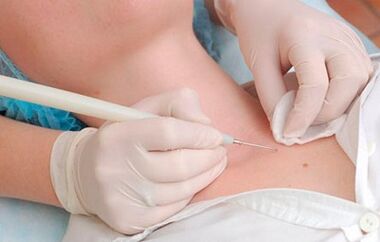 Le cause del virus del papilloma umano