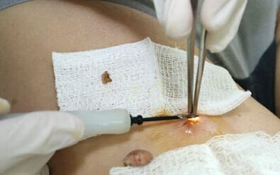 Trattamento chirurgico del virus del papilloma umano