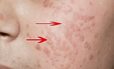 come riconoscere il virus del papilloma umano
