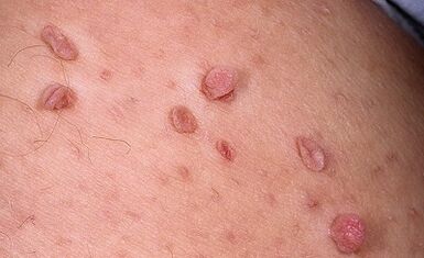 Le ragioni dell'apparizione dei papillomi sul corpo