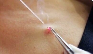 Rimozione del papilloma sul corpo con un laser