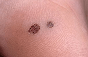 Verruca nel palmo della tua mano