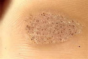 Verruca sulla pelle