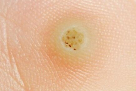 Che aspetto ha la verruca plantare