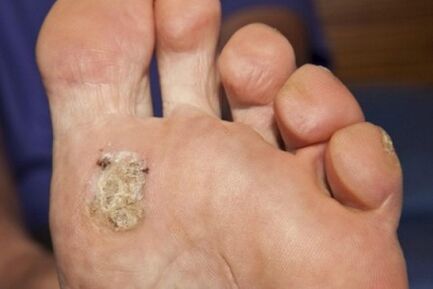 Le ragioni dell'apparizione di una verruca plantare