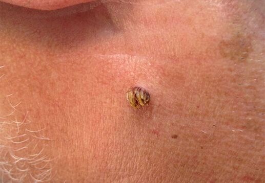 Papilloma sul collo