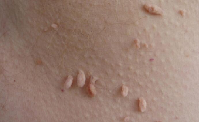 ragioni per la comparsa di papillomi sul corpo umano
