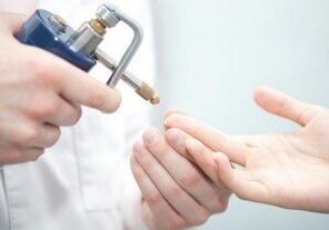 metodi moderni per rimuovere i papillomi