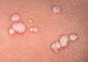 papillomi volgari sul corpo umano