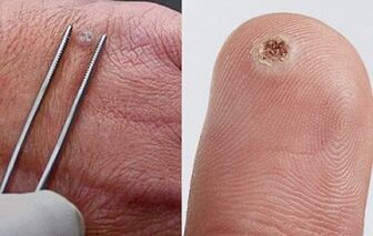 sintomi di papillomi sul corpo umano