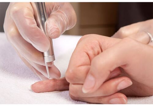 come sbarazzarsi delle verruche sul corpo