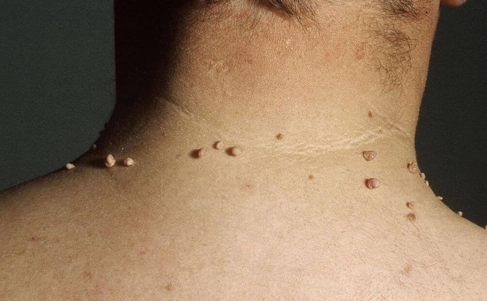 Cause di papillomi sul collo