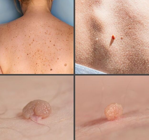 Che aspetto hanno i papillomi sul corpo