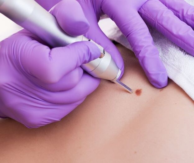 Rimozione laser del papilloma