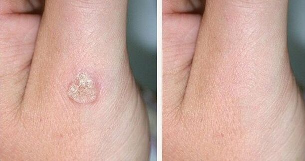 Foto prima e dopo la rimozione della verruca con rimedi naturali