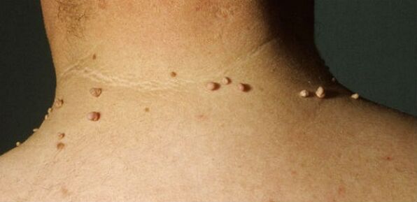 che aspetto ha il papilloma sul collo