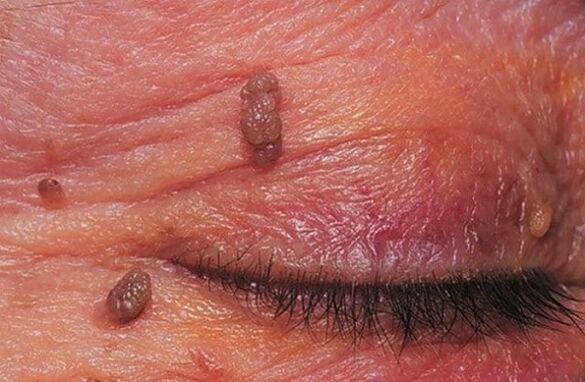 foto di papilloma sulla palpebra