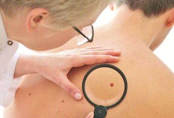 il medico determina il tipo di papilloma sulla pelle