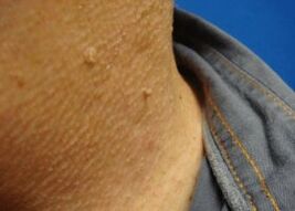 Papillomi filamentosi sul collo