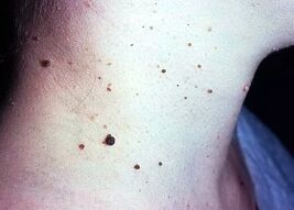 papillomi scuri sul collo di una persona